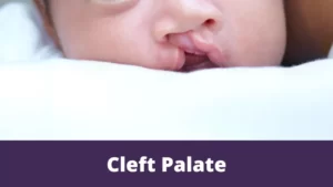 Cleft Palate