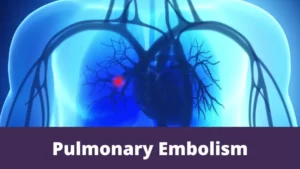 Pulmonary Embolism
