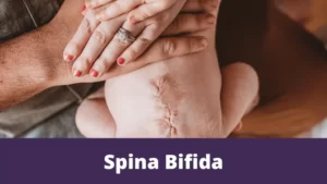 Spina bifida