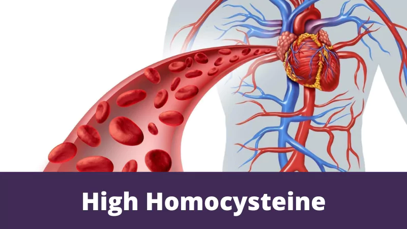 High Homocysteine