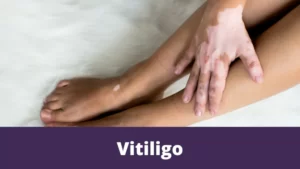 Vitiligo