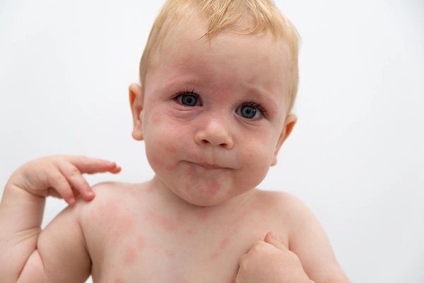 allergy